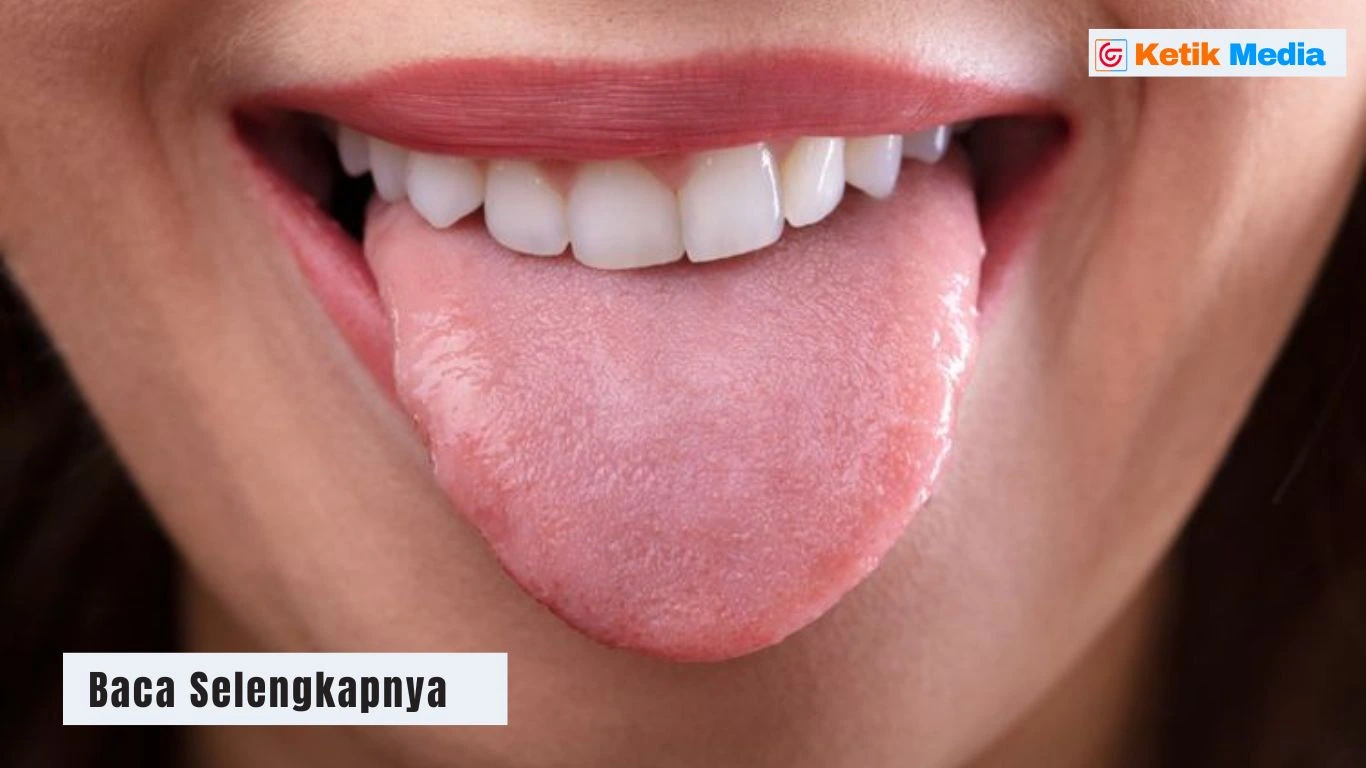 Cara mengobati sariawan di lidah