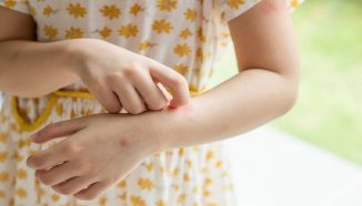 Kenali Perbedaan Campak dan Alergi untuk Penanganan yang Lebih Baik