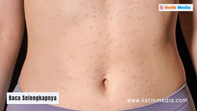 Jerawat di Perut: Penyebab Utama dan Cara Mengatasinya