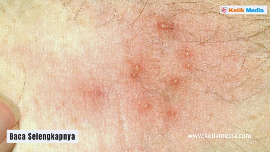 obat bentol bentol dan gatal pada buah zakar di apotik