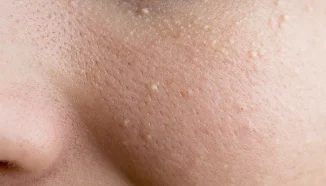 Cara Menghilangkan Bintik Putih di Wajah, Lengkap & Aman