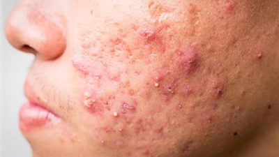 Cara menghilangkan jerawat batu di pipi