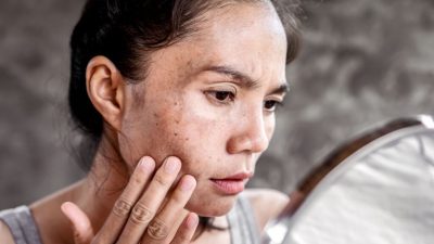 Laser Penghilang Flek Hitam: Pengertian, Manfaat dan Biaya