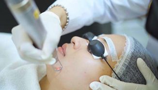 Laser Untuk Flek Hitam, Amankah?