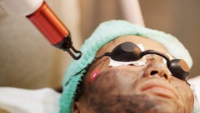 Treatment untuk Flek Hitam