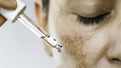 Treatment Flek Hitam: Pengertian dan Fungsinya