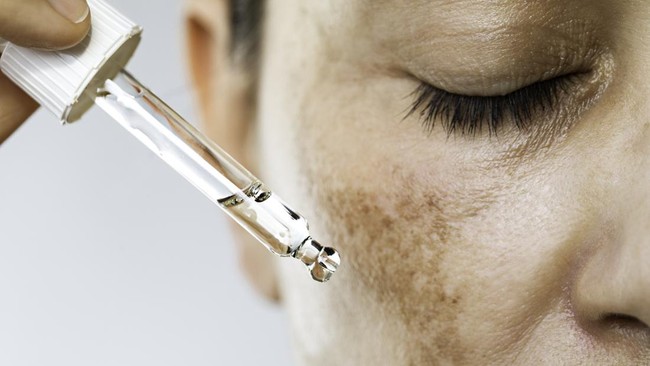 Treatment Flek Hitam