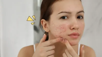 cara mengatasi jerawat meradang
