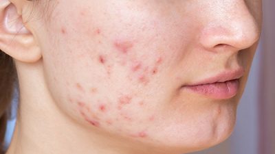 cara menghilangkan PIE