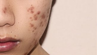 6 Cara Menghilangkan Bekas Jerawat Hitam di Pipi Secara Alami