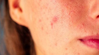 Cara Menghilangkan Bekas Jerawat Merah Paling Efektif