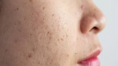 cara menghilangkan dark spot di wajah