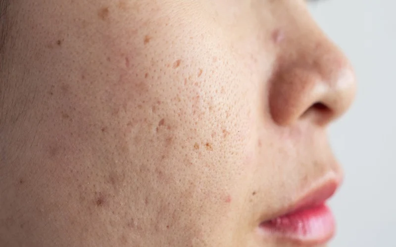 cara menghilangkan dark spot di wajah