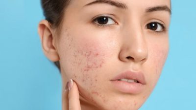 cara menghilangkan jerawat di pipi secara alami