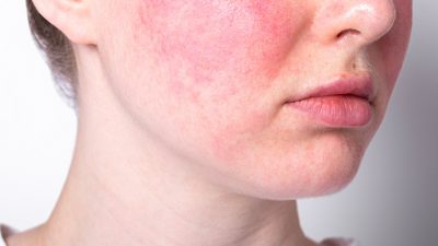 cara menghilangkan kemerahan di wajah