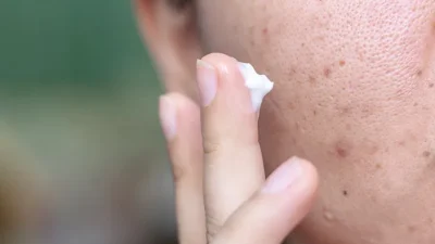 flek hitam di hidung