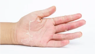 Penyebab Kulit Tangan Kering dan Cara Mencegahnya