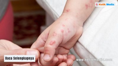 penyakit impetigo