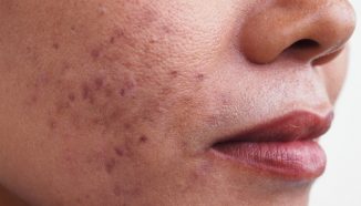 7 Cara Menghilangkan Jerawat PIH, Paling Efektif