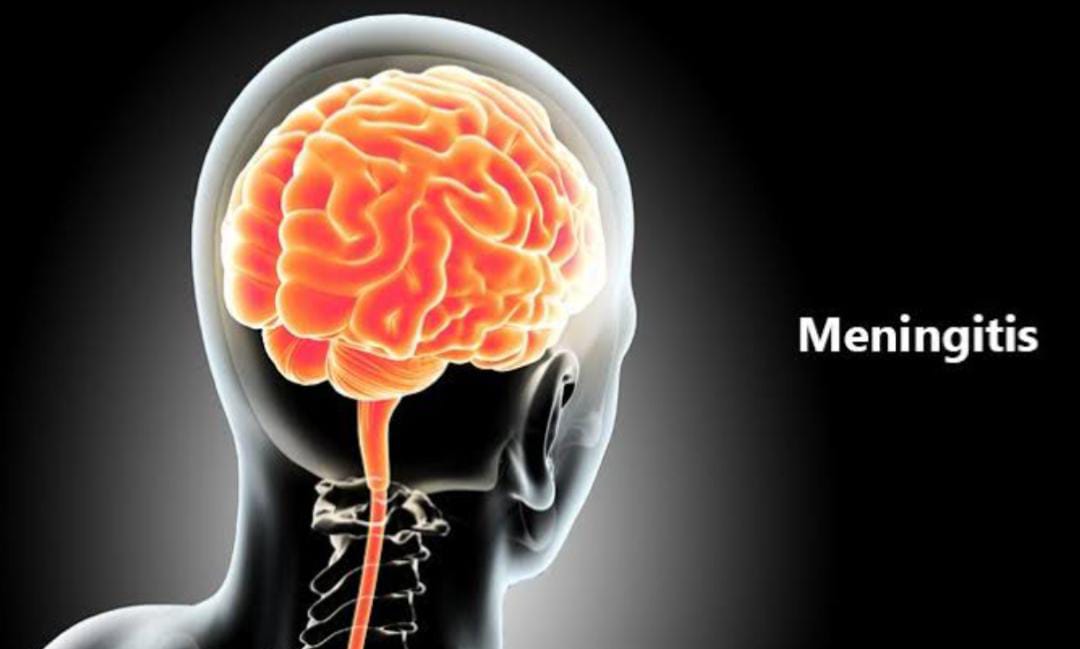 bahaya meningitis