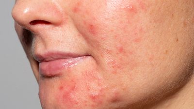 cara menghilangkan jerawat merah di pipi