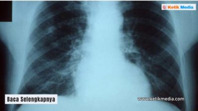 5 Tanda yang Menunjukkan Hasil Rontgen Paru-Paru Basah