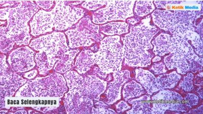 Komplikasi Pneumonia yang Bisa Berakibat Fatal Yang Wajib Ketahui