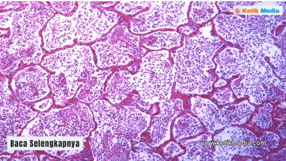 komplikasi pneumonia