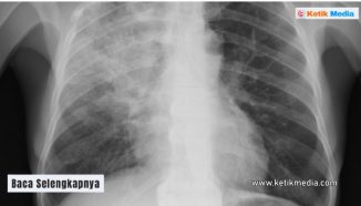 Pneumonia Klebsiella Pneumoniae: Ini Gejalanya