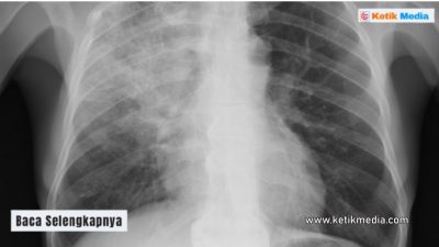 Pneumonia Klebsiella Pneumoniae: Ini Gejalanya Pneumonia klebsiella pneumoniae adalah salah satu jenis infeksi paru-paru yang terjadi karena bakteri klebsiella pneumoniae. Radang paru-paru yang disebabkan oleh klebsiella pneumoniae tergolong dalam penyakit yang serius. Mengutip laman pafikabupatenpelalawan.org, infeksi paru-paru jenis pneumonia klebsiella pneumoniae sering kali menyerang individu dengan tingkat imunitas tubuh yang lemah. 5 Gejala Pneumonia Klebsiella Pneumoniae Agar tidak keliru, simak informasi Kutip Media mengenai gejala pneumonia klebsiella pneumoniae. Gejala yang timbul perlu mendapatkan perhatian lebih lanjut agar tidak membahayakan kondisi tubuh. 1. Demam Tinggi Apa itu pneumonia klebsiella pneumoniae? Penyakit ini merupakan peradangan paru-paru yang terjadi karena perkembangan bakteri klebsiella pneumoniae penyebab pneumonia. Bakteri klebsiella pneumoniae tergolong dalam keluarga bakteri enterobacteriaceae. Secara umum, bakteri ini sering kali terdapat pada organ pencernaan manusia. Namun, dalam keadaan tertentu keberadaannya justru menyebabkan penyakit yang membahayakan. Infeksi akibat bakteri ini memiliki tanda berupa demam dengan suhu tinggi. Demam tinggi menjadi gejala pertanda khas yang menunjukkan adanya infeksi serius pada tubuh penderita. Bahkan, demam yang diderita oleh bisa mencapai 39 derajat. Kondisi demam tinggi yang terjadi pada tubuh penderita dapat bertahan selama berhari-hari. 2. Batuk Bakteri klebsiella pneumoniae menyebabkan pneumonia yang cukup parah. Penderitanya sering kali mengalami batuk dengan dahak yang kental. Warna dahak yang keluar biasanya berwarna cokelat agak kemerahan. Infeksi yang terjadi di paru-paru mengakibatkan produksi lendir yang tebal dan memiliki warna tidak normal. Tentu saja gejala batuk yang terdapat pada tubuh penderita terasa sangat mengganggu. Dalam kondisi parah, batuk yang terjadi akan semakin keras. Volume batuk juga ikut semakin meningkat. Gejala-gejala lain mulai terasa pada tubuh penderita ketika berada dalam keadaan ini. Obat pereda batuk menjadi salah satu kebutuhan wajib bagi penderita pneumonia. 3. Sesak Napas Salah satu patogen yang mengakibatkan pneumonia adalah klebsiella pneumoniae. Penderita pneumonia sering kali mengalami gejala sesak nafas. Infeksi yang terjadi di bagian paru-paru membuatkan pertukaran oksigen menjadi terhambat. Sesak napas yang terus-menerus terjadi membuat kualitas tidur penderita menjadi menurun. Dalam keadaan ini, aktivitas sehari-hari yang dilakukan oleh penderita menjadi terganggu. Perawatan pneumonia di rumah sakit kerap memanfaatkan alat bantu pernapasan. Jika tidak segera memperoleh pengobatan, penderita bisa mengalami masalah pernapasan yang serius. Penderita mudah mengalami napas yang terengah-engah meski hanya melakukan aktivitas yang bersifat ringan. 4. Nyeri pada Bagian Dada Gejala lain yang kerap terjadi pada penderita pneumonia yakni nyeri pada bagian dada. Pengobatan radang paru-paru klebsiella pneumoniae terdiri dari sejumlah langkah. Salah satu fokus pengobatannya bertujuan untuk mengurangi nyeri dada yang ada pada tubuh pasien. Jaringan paru-paru yang meradang mengakibatkan rasa sakit yang menekan area dada. Rasa sakit semakin terasa parah ketika penderita mengalami batuk. Selain itu, penderita juga bisa merasakan rasa nyeri ketika menarik napas. Pneumonia yang terjadi karena klebsiella pneumoniae memiliki gejala yang cukup berat. Nyeri yang terasa pada dada memberi sensasi tidak nyaman. Lambat laun penderita akan merasakan cemas karena kondisi tubuhnya yang menurun. 5. Tubuh yang Lemah Pengobatan pneumonia klebsiella pneumoniae bertujuan untuk menyerang pertumbuhan bakteri menggunakan berbagai jenis obat. Termasuk antibiotik pneumonia klebsiella pneumoniae. Penyakit pneumonia klebsiella pneumoniae ditandai dengan kondisi tubuh yang melemah. Infeksi bakteri yang terjadi mengakibatkan pergerakan tubuh tidak berjalan secara normal. Sistem kekebalan tubuh bekerja keras menyerang bakteri yang ada di paru-paru. Asupan makanan yang berkurang juga menjadi salah satu penyebab kondisi tubuh semakin melemah. Penderita pneumonia jenis ini cenderung mengalami penurunan nafsu makan dibandingkan dalam kondisi normal.