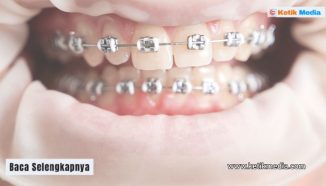 Informasi Terbaru Harga Pasang Behel Gigi Atas di Dental Clinic