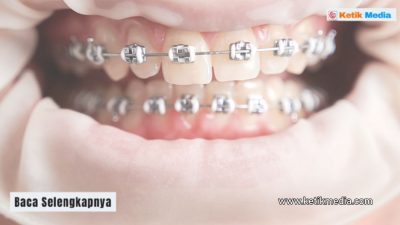 Informasi Terbaru Harga Pasang Behel Gigi Atas di Dental Clinic