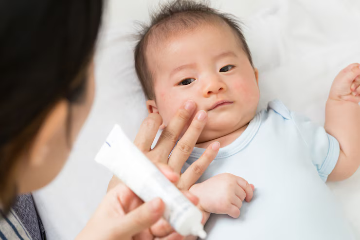 Obat Salep Biang Keringat Bayi di Apotik
